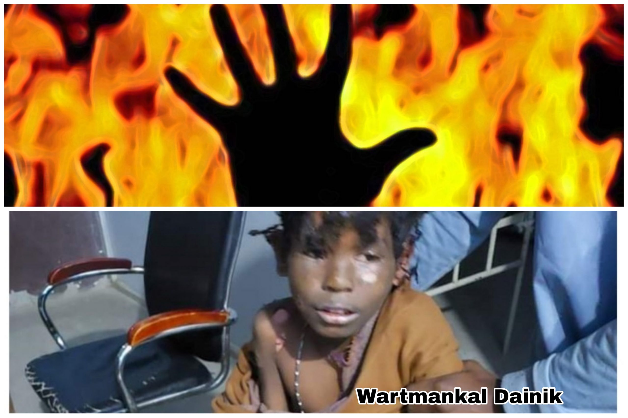 आगलगीमा घाइते बालकको उपचारको क्रममा मृत्यु