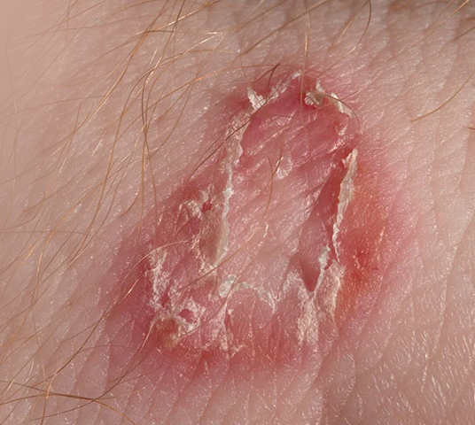 किन आउंछ छालामा दाद ?