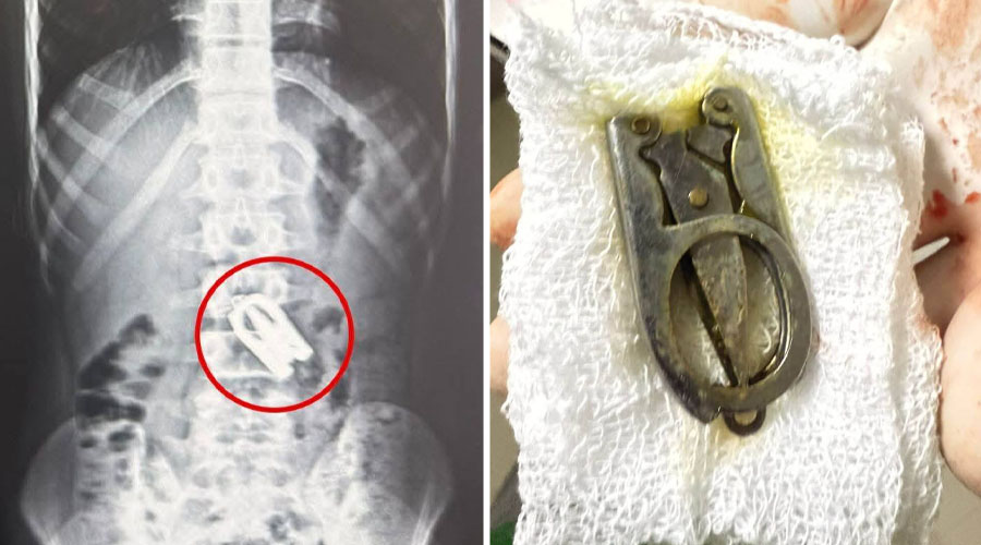 १५ वर्षीय बालकको पेटमा अड्किएको कैंची शल्यक्रियाबाट निकालियो