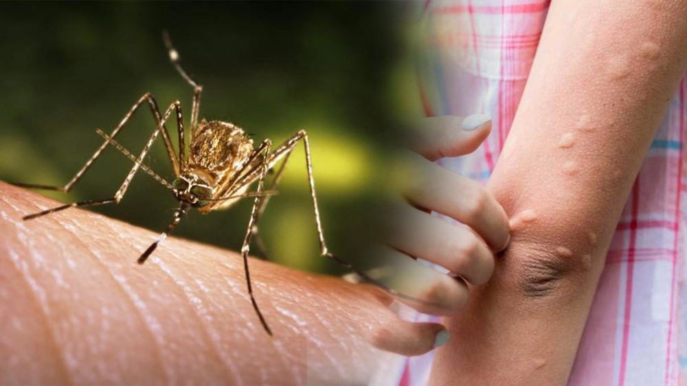 जापानिज इन्सेफलाइटिसबाट मधेश प्रदेशमा चारजनासहित २० जनाको मृत्यु