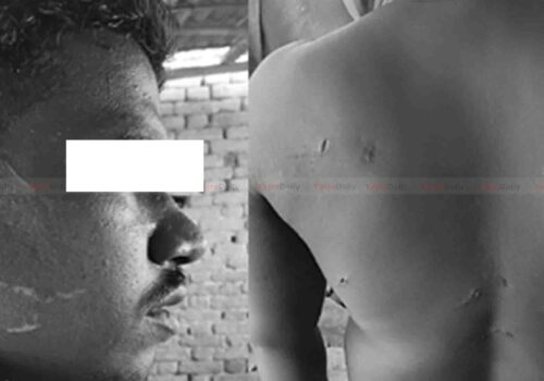 रौतहटमा कामदारमाथि छुरा प्रहार, पीडित पक्षले मेलमिलापको दबाब दिएको आरोप