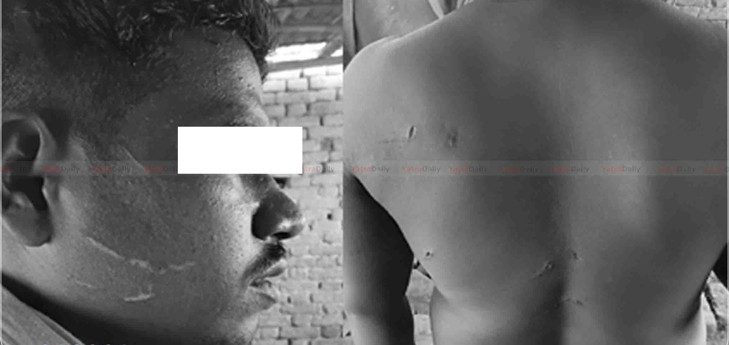 रौतहटमा कामदारमाथि छुरा प्रहार, पीडित पक्षले मेलमिलापको दबाब दिएको आरोप